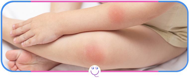 Pediatric Sunburns Treatment Specialist Near Me in Memphis, TN Pediatric Sunburns Treatment Specialist Near Me in Memphis, TN